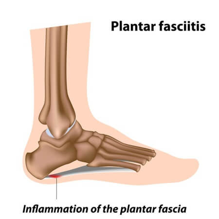 Plantar-fasciitis-heel-pain