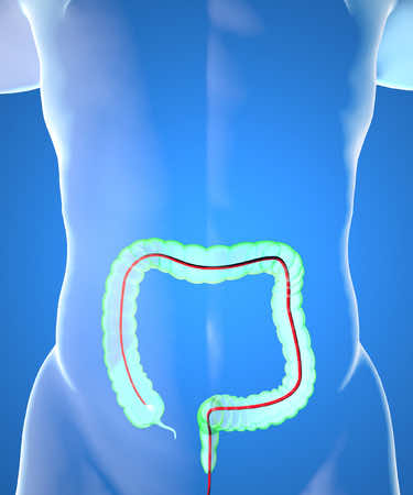 Colonoscopy, Bowel cancer screening
