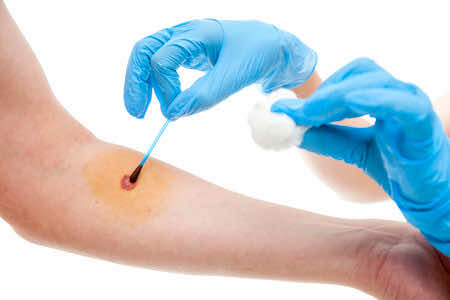 iodine-solution-prevent-infection