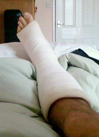 Broken Bone pain