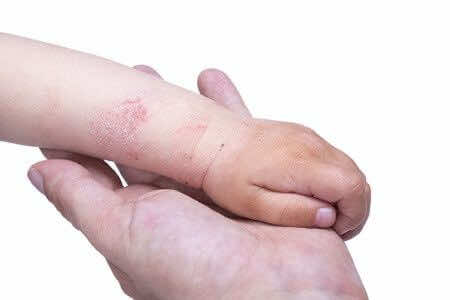 Eczema in babies
